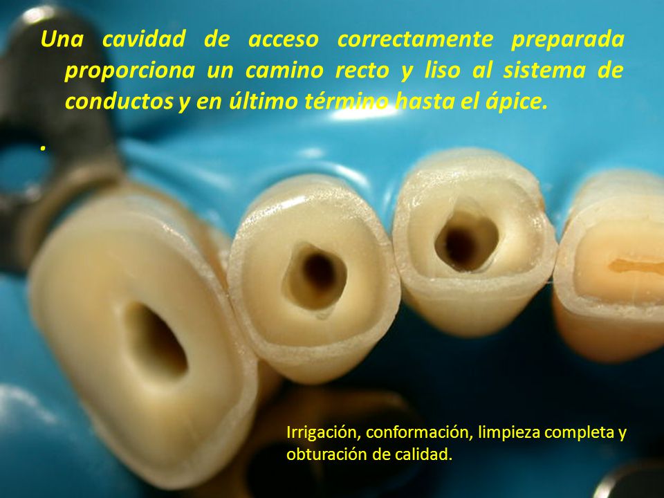 Una cavidad de acceso correctamente preparada proporciona un camino recto y liso al sistema de conductos y en último término hasta el ápice.