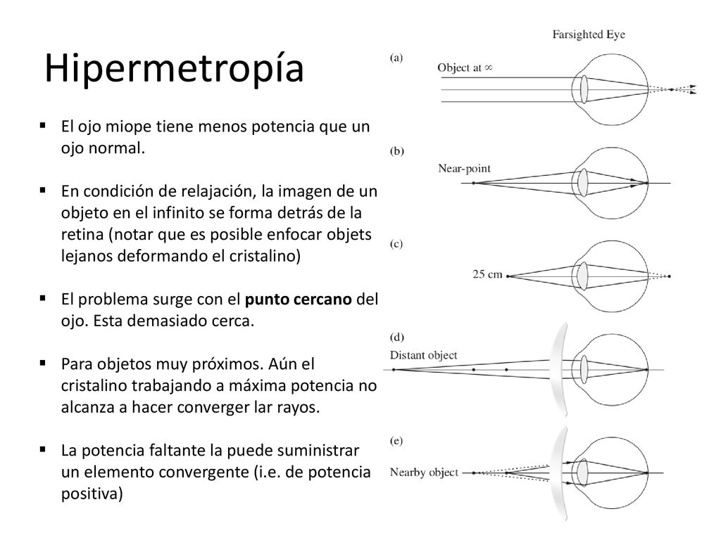Hipermetropía El ojo miope tiene menos potencia que un ojo normal.