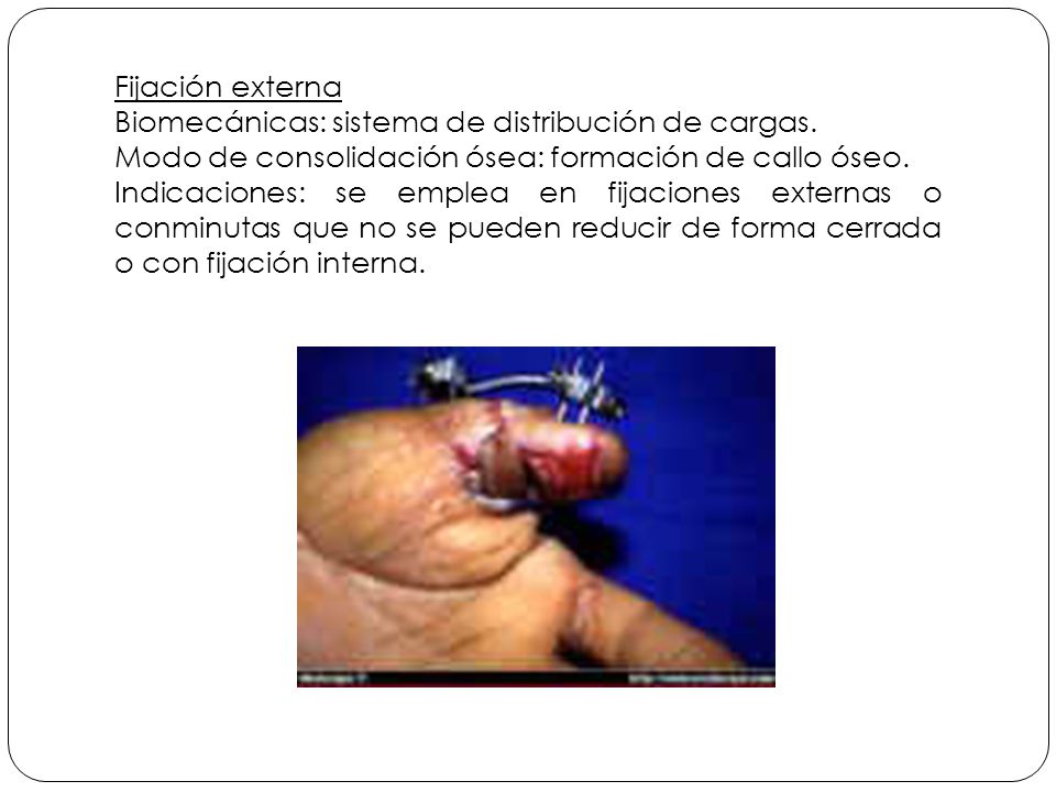 Fijación externa Biomecánicas: sistema de distribución de cargas. Modo de consolidación ósea: formación de callo óseo.