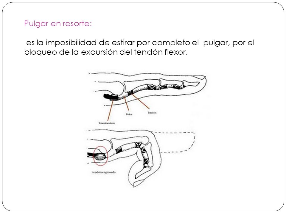 Pulgar en resorte: es la imposibilidad de estirar por completo el pulgar, por el bloqueo de la excursión del tendón flexor.