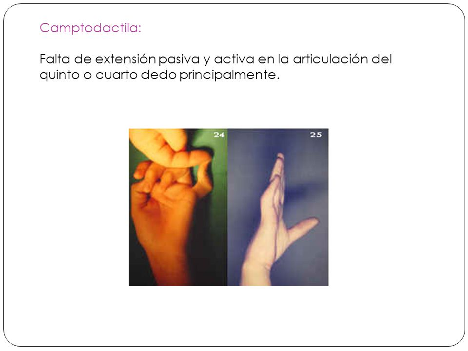 Camptodactila: Falta de extensión pasiva y activa en la articulación del quinto o cuarto dedo principalmente.