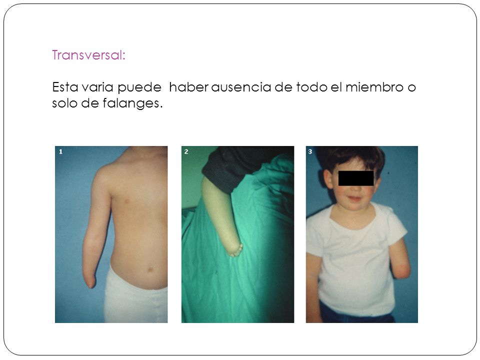 Transversal: Esta varia puede haber ausencia de todo el miembro o solo de falanges.