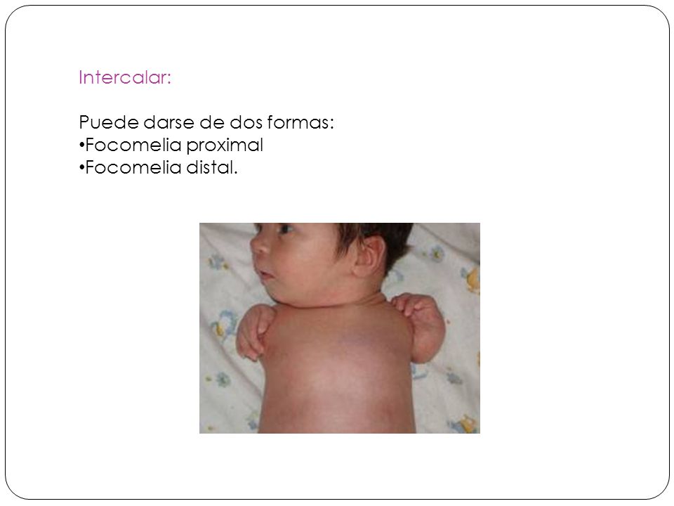 Intercalar: Puede darse de dos formas: Focomelia proximal Focomelia distal.