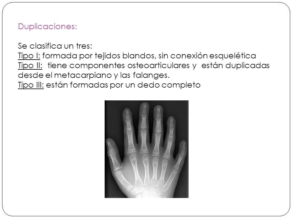 Duplicaciones: Se clasifica un tres: Tipo I: formada por tejidos blandos, sin conexión esquelética.