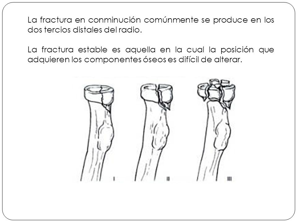 La fractura en conminución comúnmente se produce en los dos tercios distales del radio.