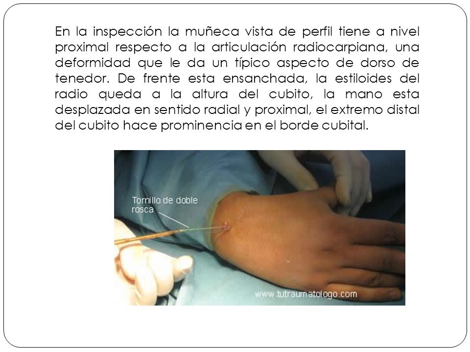 En la inspección la muñeca vista de perfil tiene a nivel proximal respecto a la articulación radiocarpiana, una deformidad que le da un típico aspecto de dorso de tenedor.