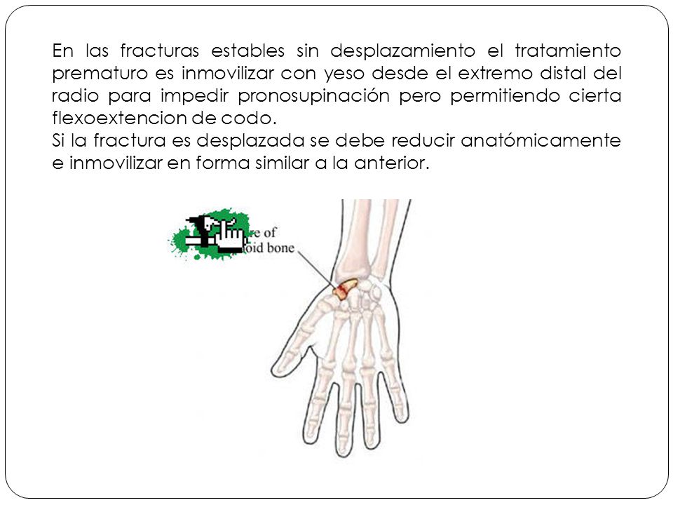 En las fracturas estables sin desplazamiento el tratamiento prematuro es inmovilizar con yeso desde el extremo distal del radio para impedir pronosupinación pero permitiendo cierta flexoextencion de codo.