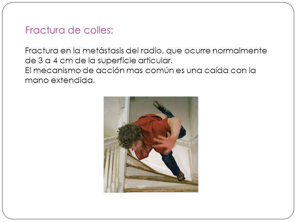 Fractura de colles: Fractura en la metástasis del radio, que ocurre normalmente de 3 a 4 cm de la superficie articular.