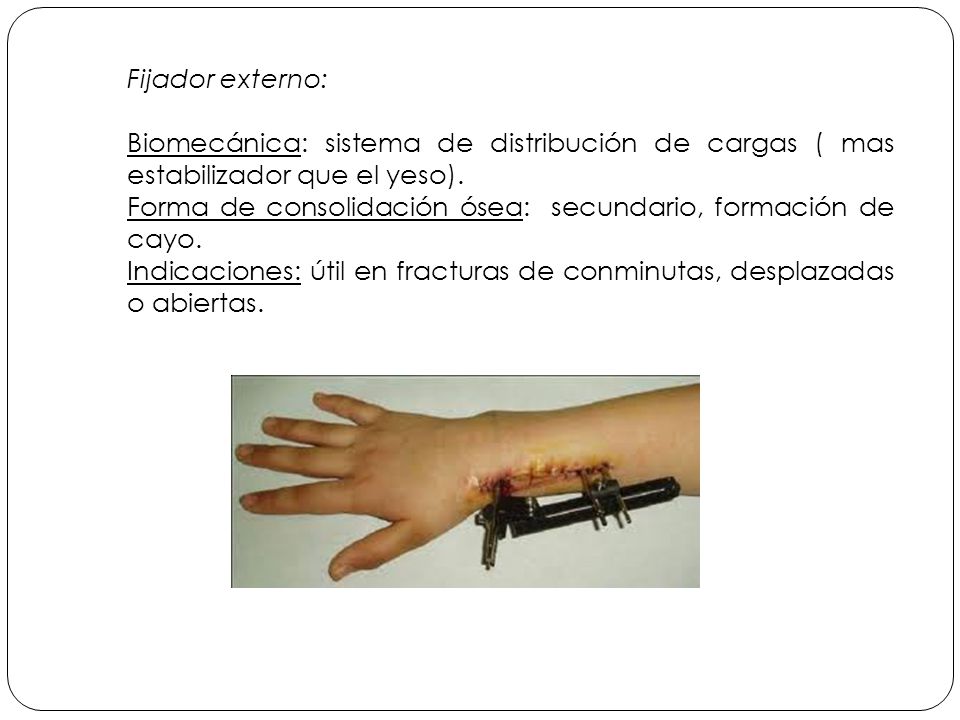 Fijador externo: Biomecánica: sistema de distribución de cargas ( mas estabilizador que el yeso).
