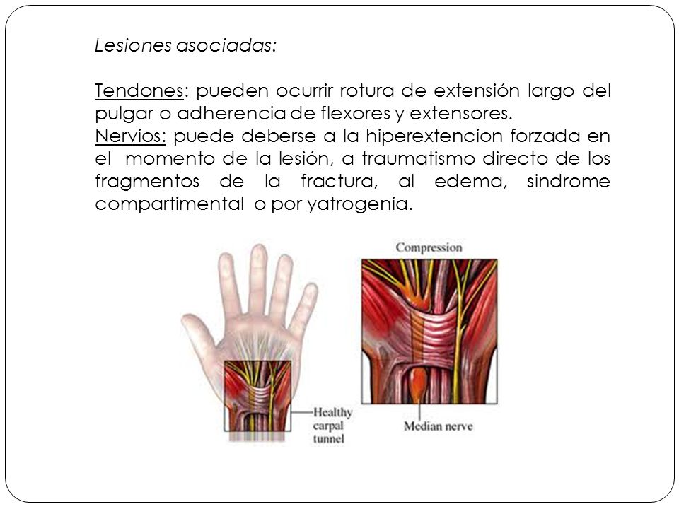 Lesiones asociadas: Tendones: pueden ocurrir rotura de extensión largo del pulgar o adherencia de flexores y extensores.