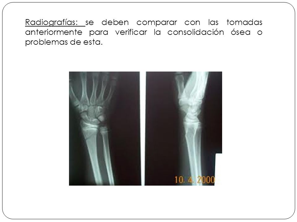Radiografías: se deben comparar con las tomadas anteriormente para verificar la consolidación ósea o problemas de esta.