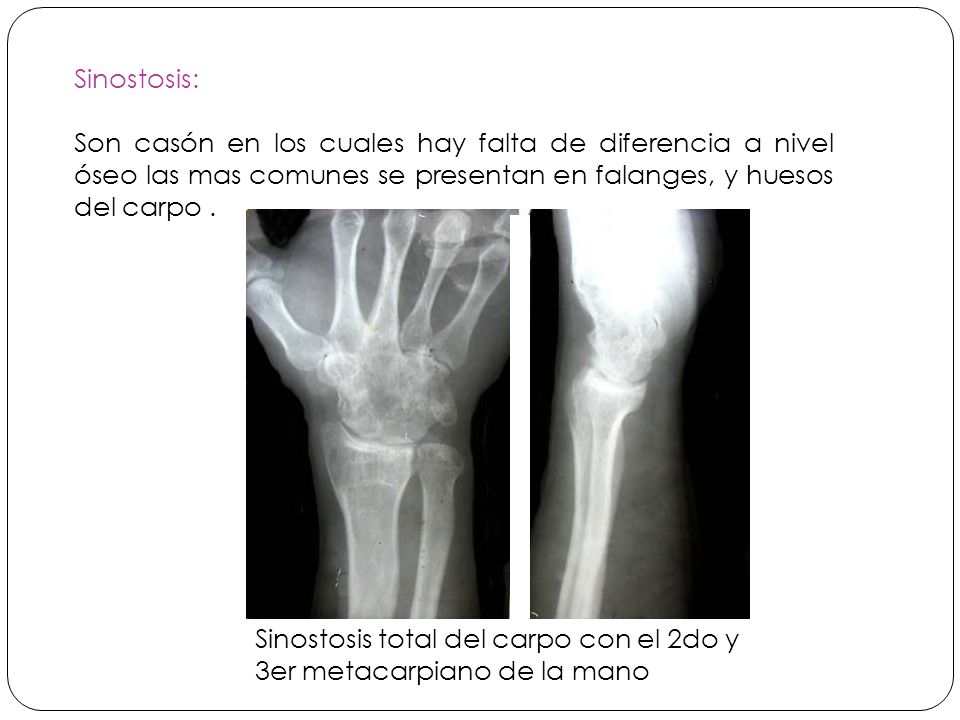 Sinostosis: Son casón en los cuales hay falta de diferencia a nivel óseo las mas comunes se presentan en falanges, y huesos del carpo .