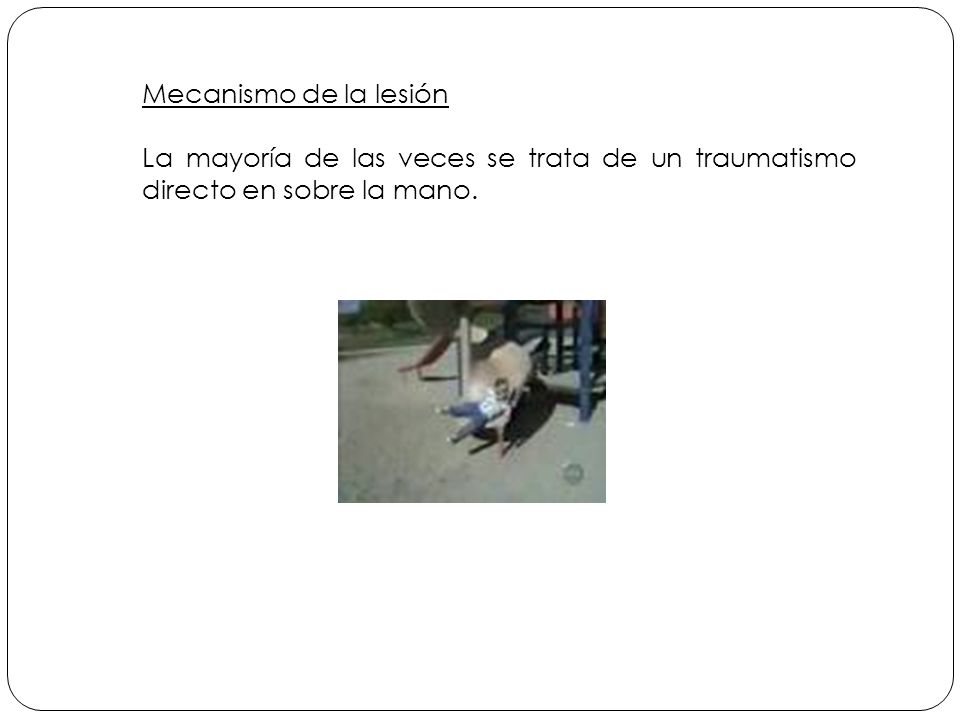 Mecanismo de la lesión La mayoría de las veces se trata de un traumatismo directo en sobre la mano.