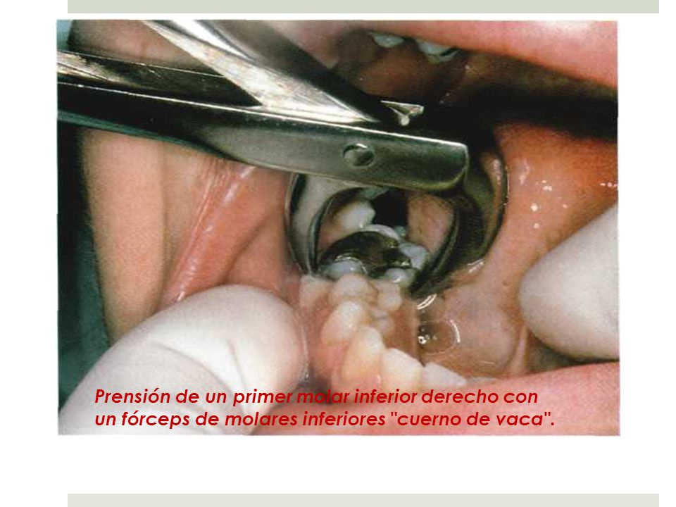 Prensión de un primer molar inferior derecho con un fórceps de molares inferiores cuerno de vaca .