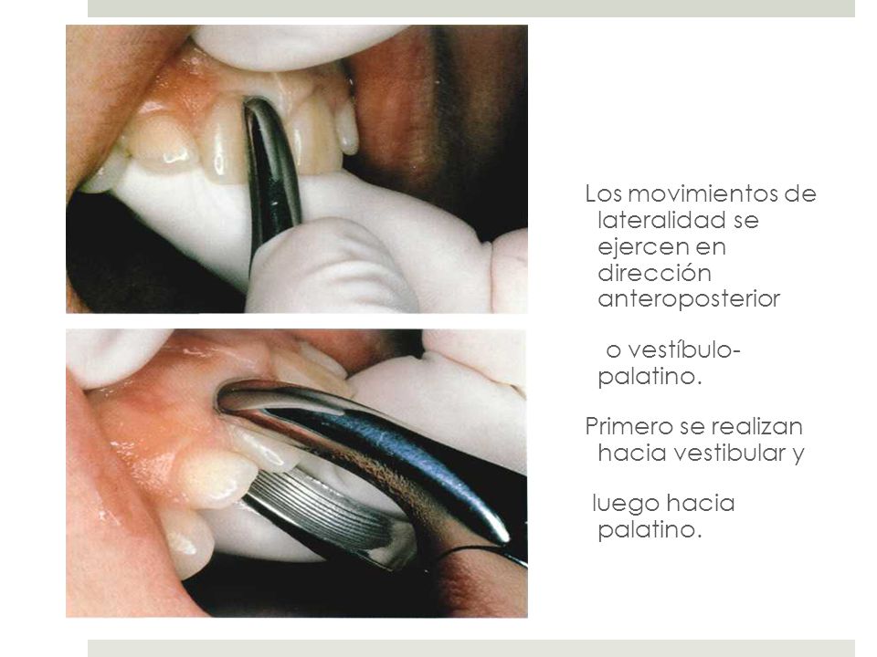 Los movimientos de lateralidad se ejercen en dirección anteroposterior o vestíbulo- palatino.