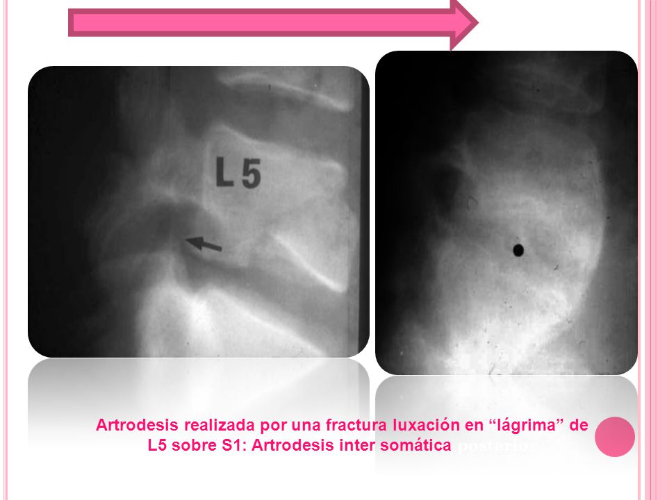 Artrodesis realizada por una fractura luxación en lágrima de L5 sobre S1: Artrodesis inter somática posterior