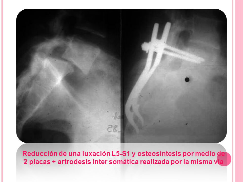 Reducción de una luxación L5-S1 y osteosíntesis por medio de 2 placas + artrodesis inter somática realizada por la misma vía