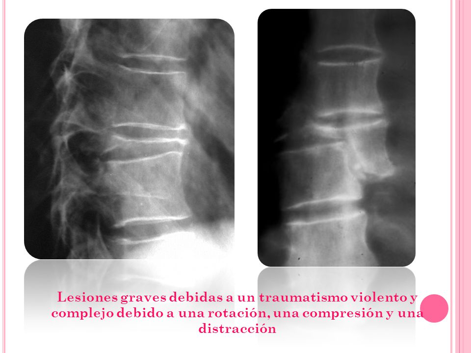 Lesiones graves debidas a un traumatismo violento y complejo debido a una rotación, una compresión y una distracción