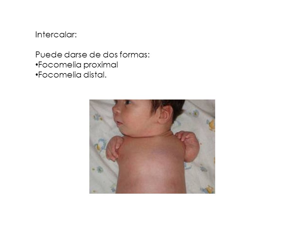 Intercalar: Puede darse de dos formas: Focomelia proximal Focomelia distal.