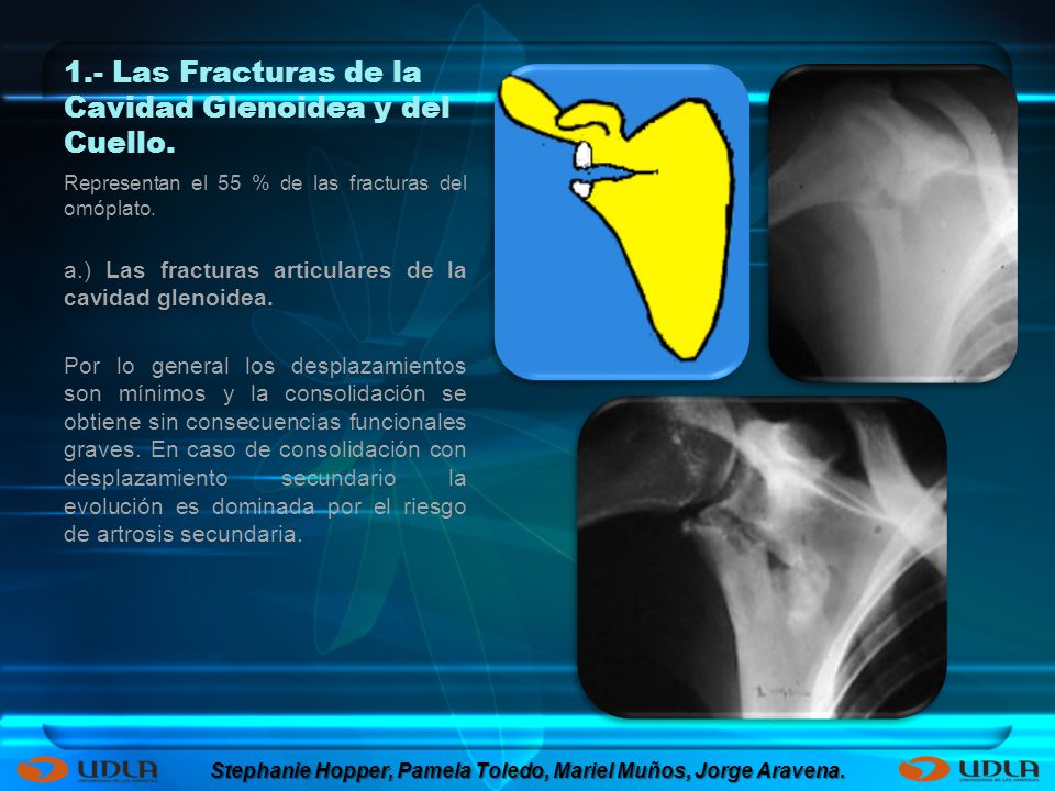 1.- Las Fracturas de la Cavidad Glenoidea y del Cuello.