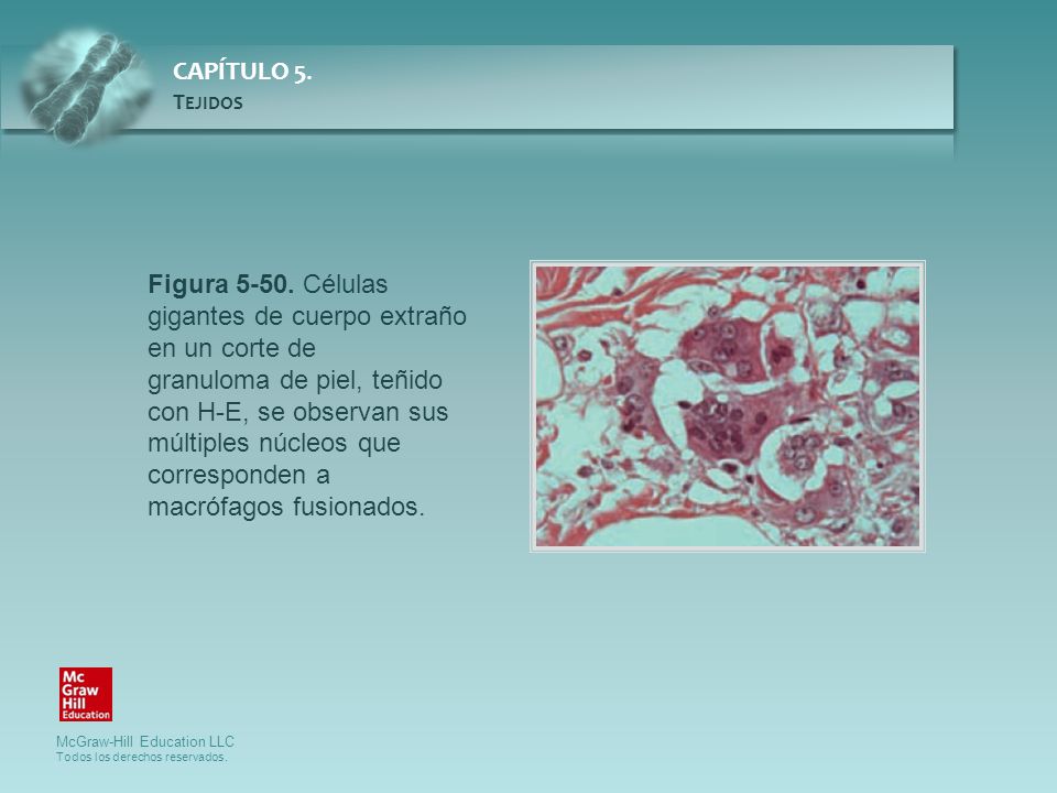 Figura Células gigantes de cuerpo extraño en un corte de