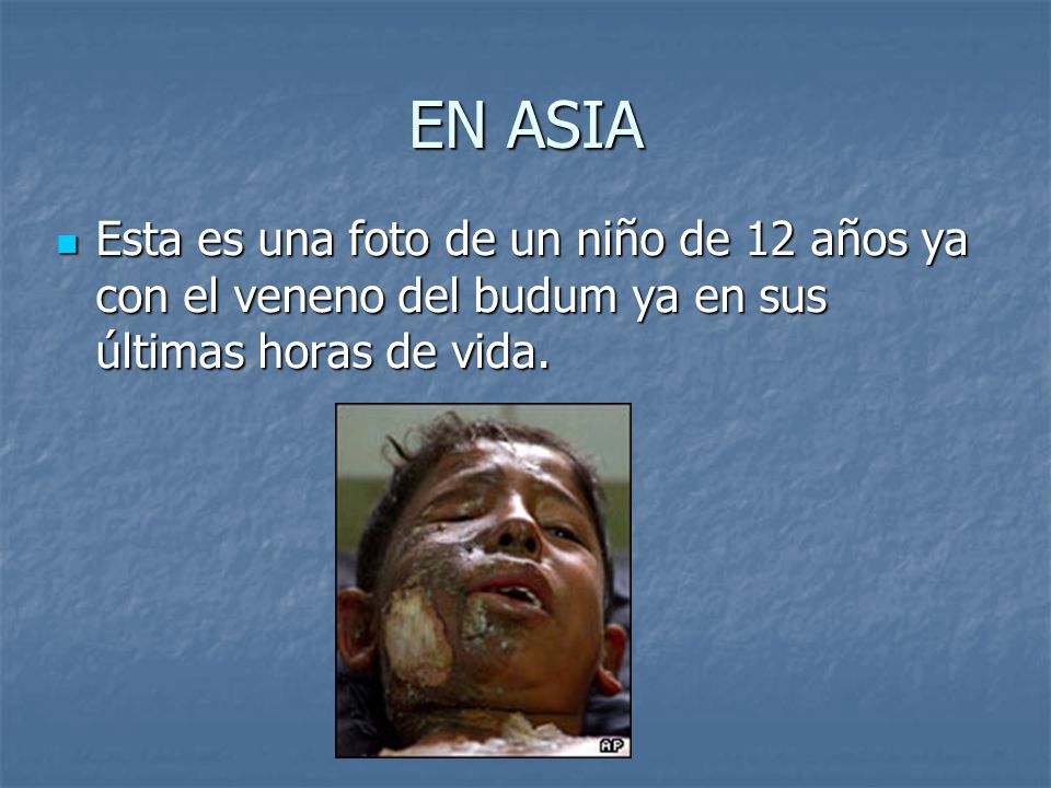 EN ASIA Esta es una foto de un niño de 12 años ya con el veneno del budum ya en sus últimas horas de vida.