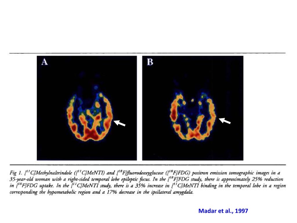 Interictal PET has revealed increases in both mu and delta opioid receptors in neocortex overlying limbic structures of patients with MTLE. These changes correlates with hypometabolic activity in the same area.