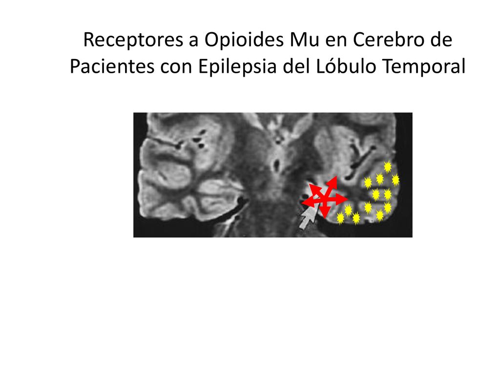Receptores a Opioides Mu en Cerebro de Pacientes con Epilepsia del Lóbulo Temporal