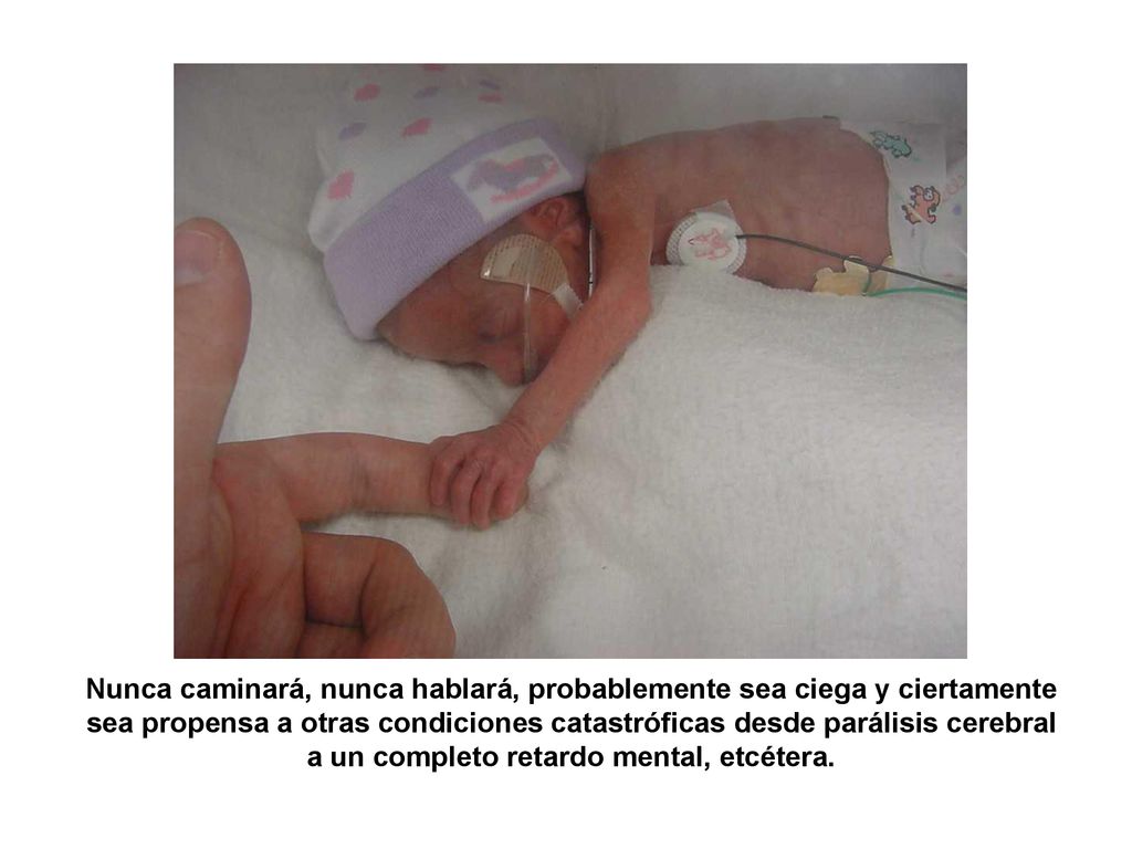 Nunca caminará, nunca hablará, probablemente sea ciega y ciertamente sea propensa a otras condiciones catastróficas desde parálisis cerebral a un completo retardo mental, etcétera.