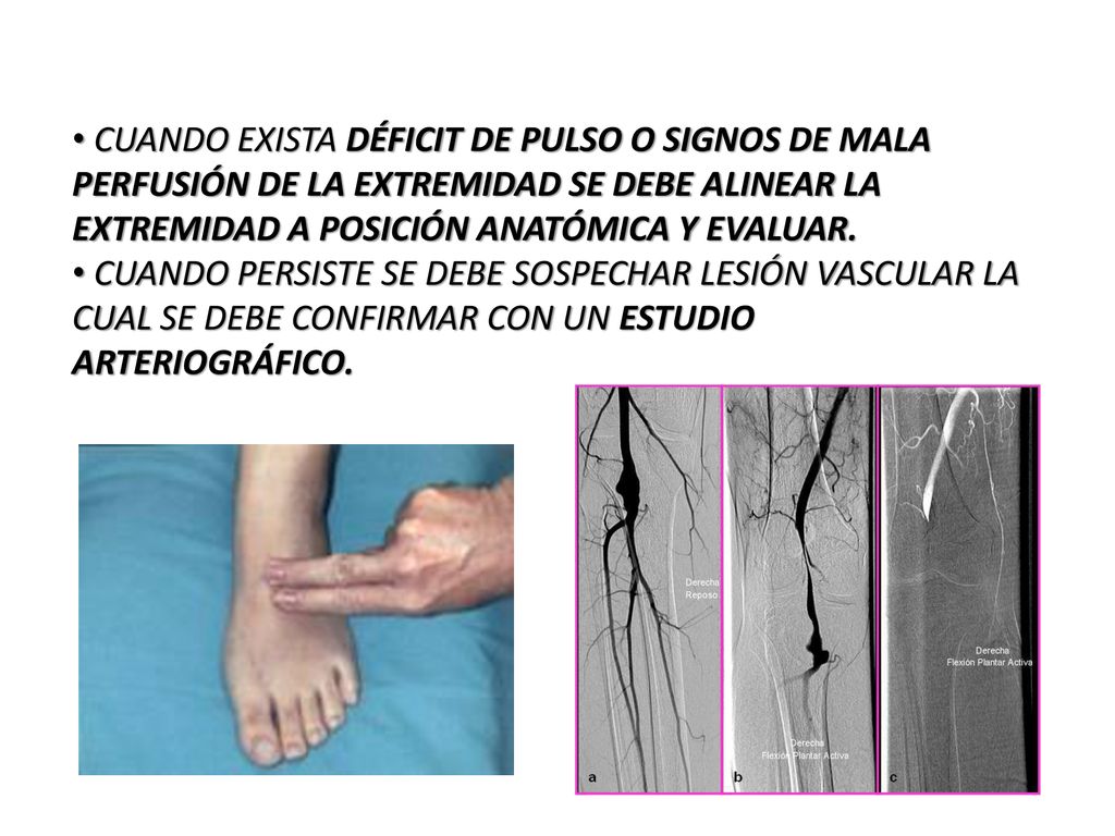 CUANDO EXISTA DÉFICIT DE PULSO O SIGNOS DE MALA PERFUSIÓN DE LA EXTREMIDAD SE DEBE ALINEAR LA EXTREMIDAD A POSICIÓN ANATÓMICA Y EVALUAR.