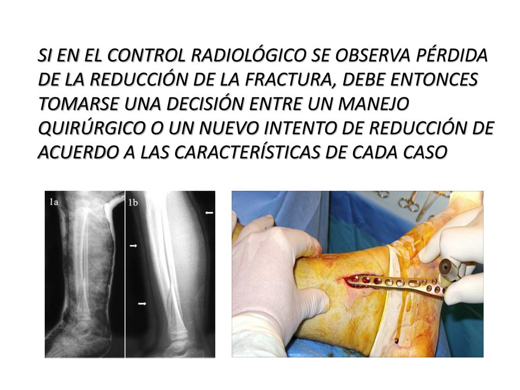 SI EN EL CONTROL RADIOLÓGICO SE OBSERVA PÉRDIDA DE LA REDUCCIÓN DE LA FRACTURA, DEBE ENTONCES TOMARSE UNA DECISIÓN ENTRE UN MANEJO QUIRÚRGICO O UN NUEVO INTENTO DE REDUCCIÓN DE ACUERDO A LAS CARACTERÍSTICAS DE CADA CASO
