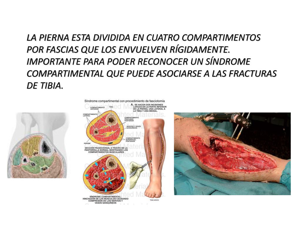 LA PIERNA ESTA DIVIDIDA EN CUATRO COMPARTIMENTOS POR FASCIAS QUE LOS ENVUELVEN RÍGIDAMENTE.