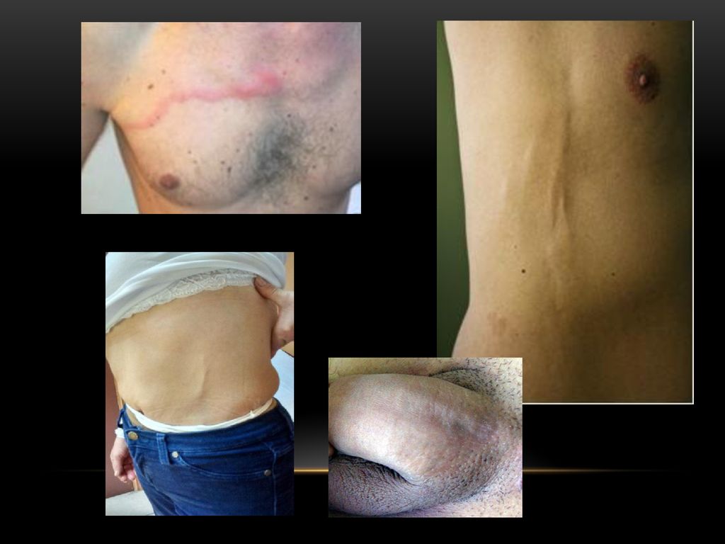 Vena dorsal supericial del pene aumentada de volumen hacia su mitad proximal y de color rojo parduzco.