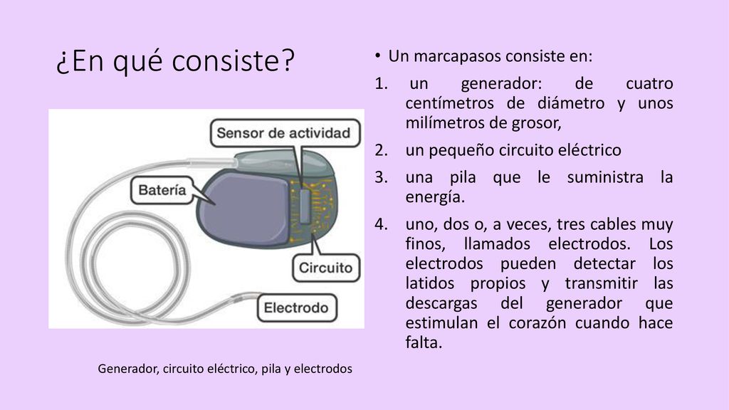 ¿En qué consiste Un marcapasos consiste en: