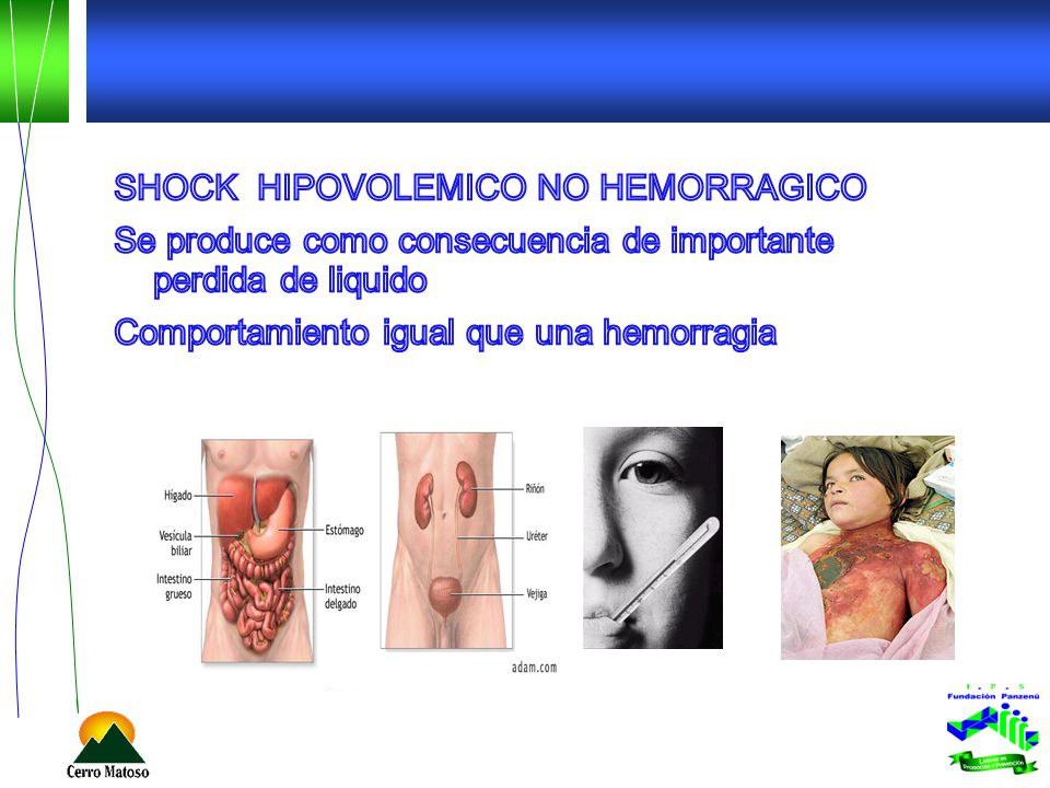 SHOCK HIPOVOLEMICO NO HEMORRAGICO