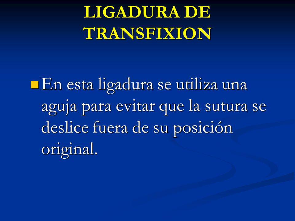 LIGADURA DE TRANSFIXION
