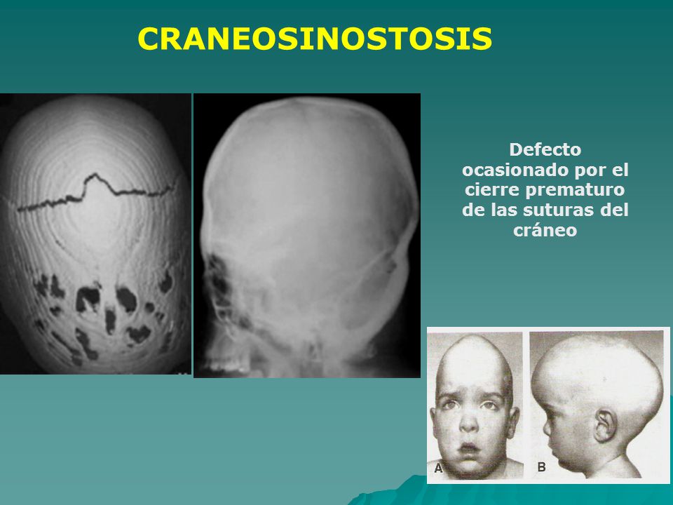 Defecto ocasionado por el cierre prematuro de las suturas del cráneo