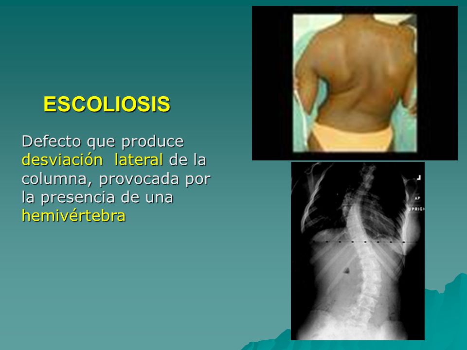 ESCOLIOSIS Defecto que produce desviación lateral de la columna, provocada por la presencia de una hemivértebra.