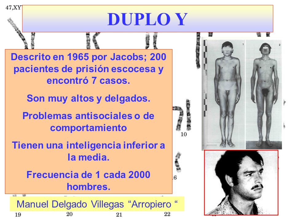 DUPLO Y Descrito en 1965 por Jacobs; 200 pacientes de prisión escocesa y encontró 7 casos. Son muy altos y delgados.