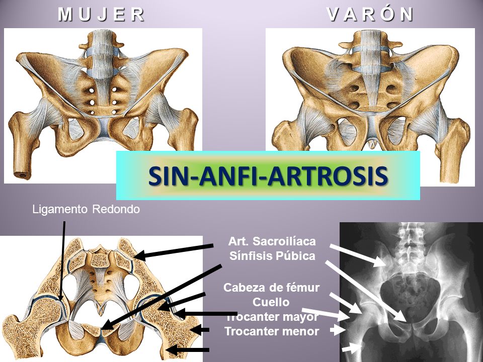 SIN-ANFI-ARTROSIS M U J E R V A R Ó N Ligamento Redondo