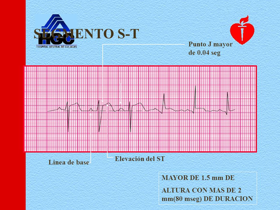 SEGMENTO S-T Punto J mayor de 0.04 seg Elevación del ST Linea de base