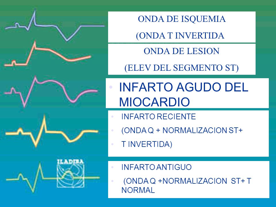 INFARTO AGUDO DEL MIOCARDIO (ONDA Q + ELEVACION ST+ T INVERTIDA)