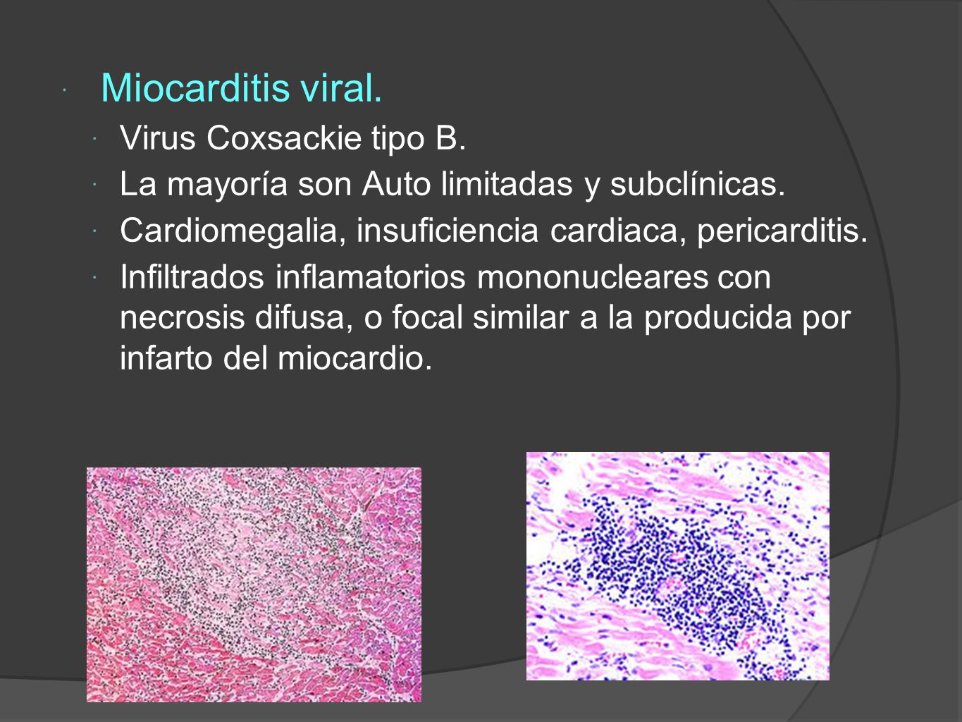 Miocarditis viral. Virus Coxsackie tipo B.