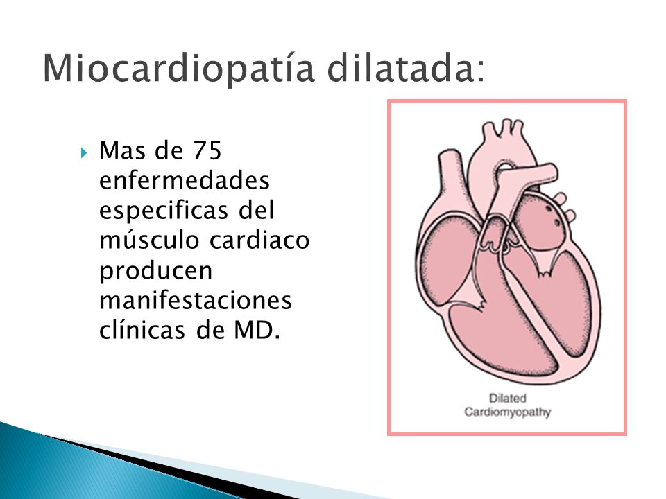 Miocardiopatía dilatada: