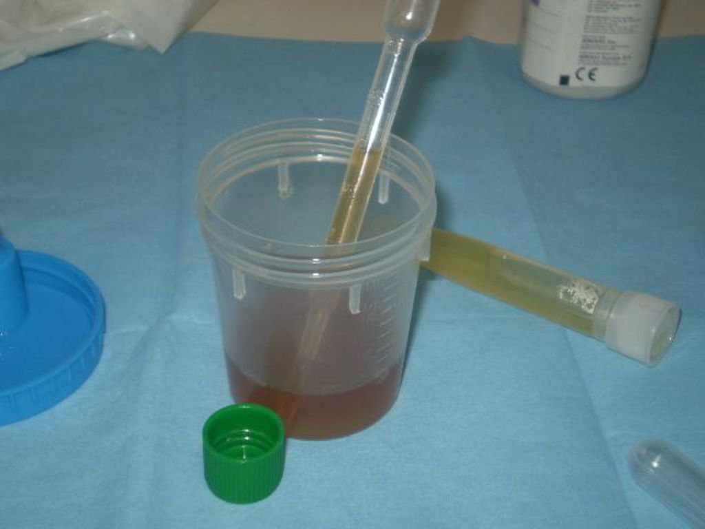 Hematuria macroscópica en orina recogida tras realizar ejercicio (caminar o subir escaleras) durante minutos.