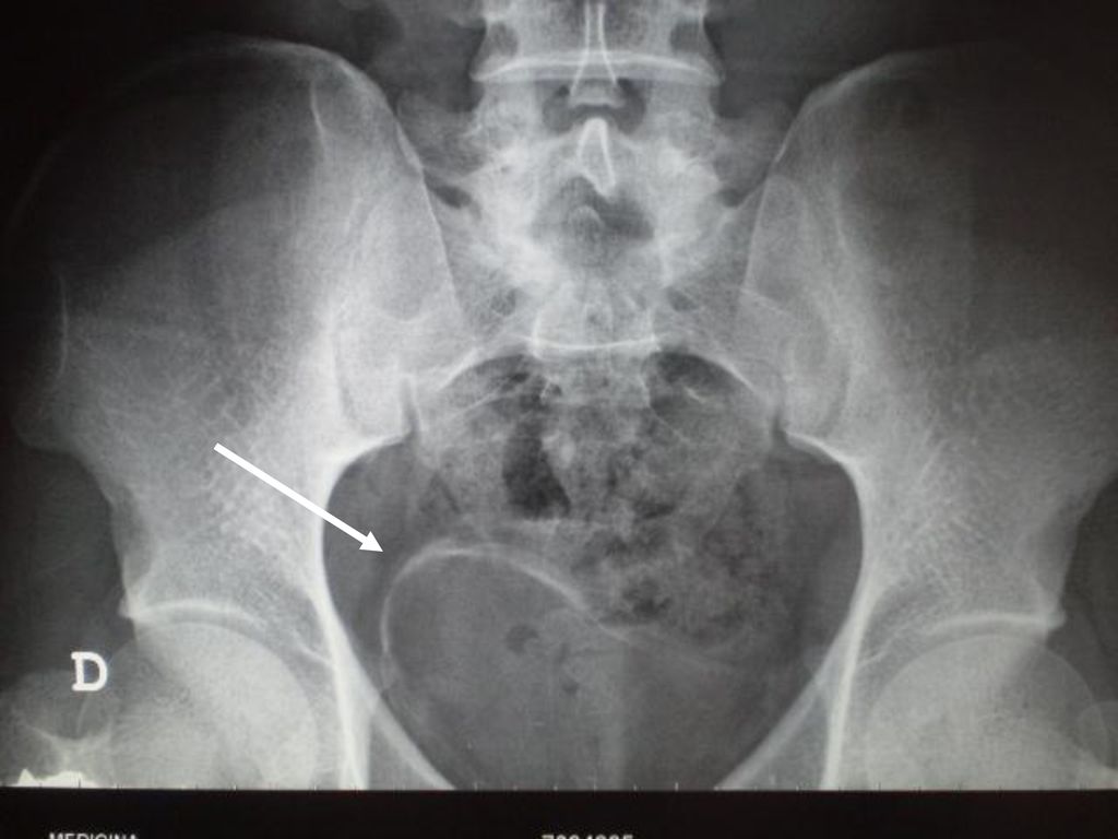 La flecha indica claramente la calcificación del contorno de la pared vesical en la pelvis del paciente.