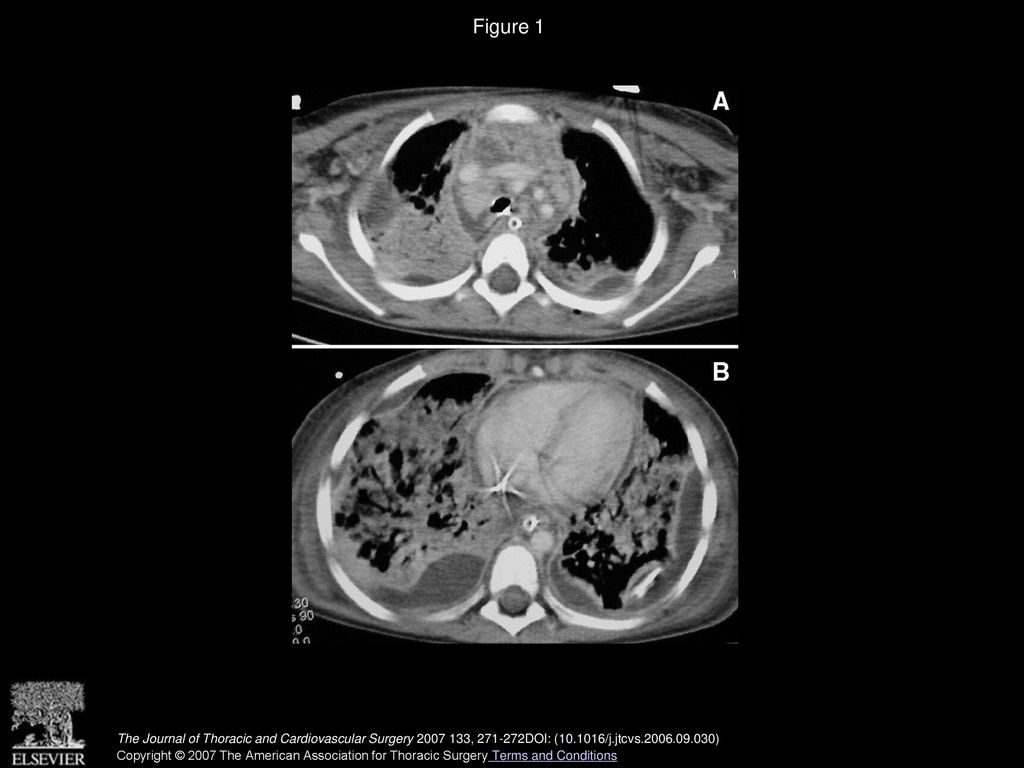 Figure 1 Chest CT scans: A, Predominant anterior and middle mediastinitis. B, Severe pneumonia and pleural effusion.