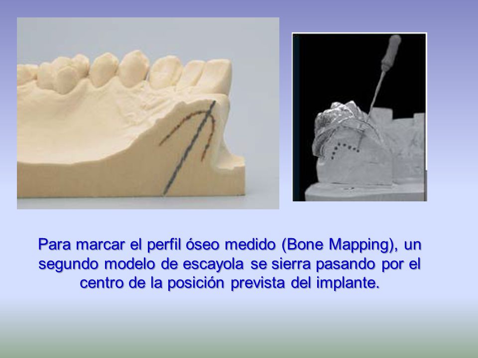 Para marcar el perfil óseo medido (Bone Mapping), un segundo modelo de escayola se sierra pasando por el centro de la posición prevista del implante.