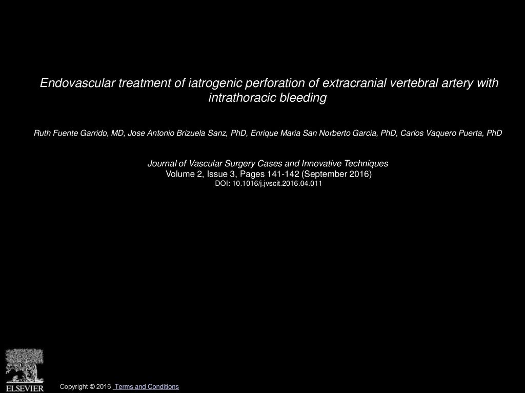 Endovascular treatment of iatrogenic perforation of extracranial vertebral artery with intrathoracic bleeding