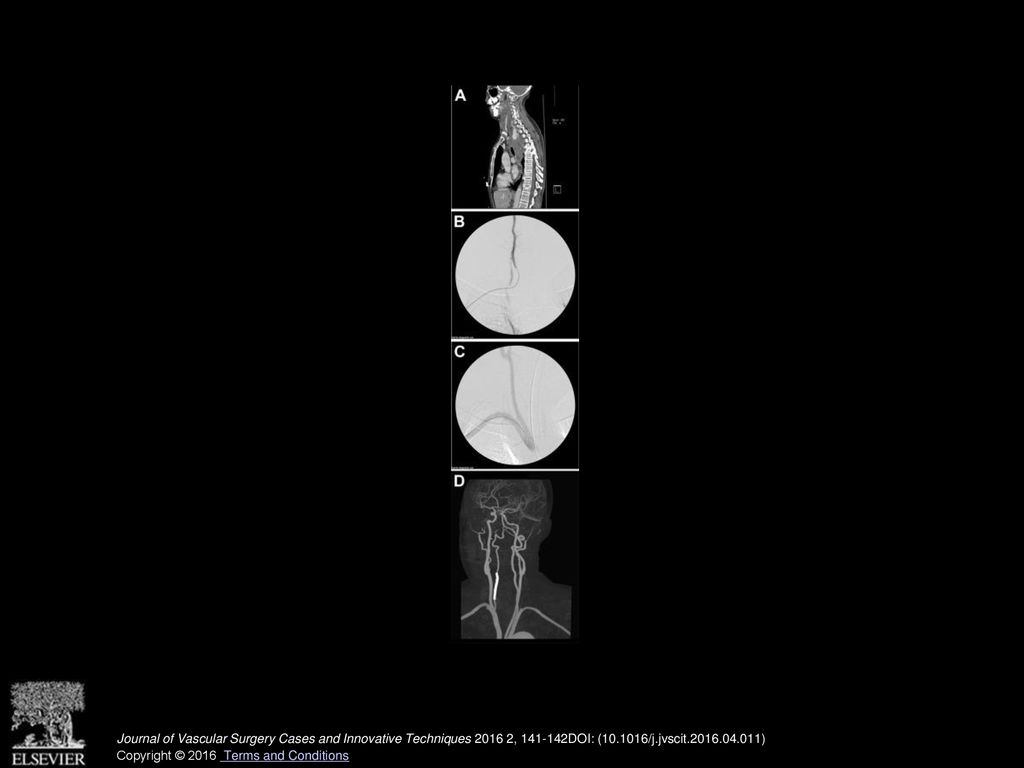 Journal of Vascular Surgery Cases and Innovative Techniques , DOI: ( /j.jvscit )